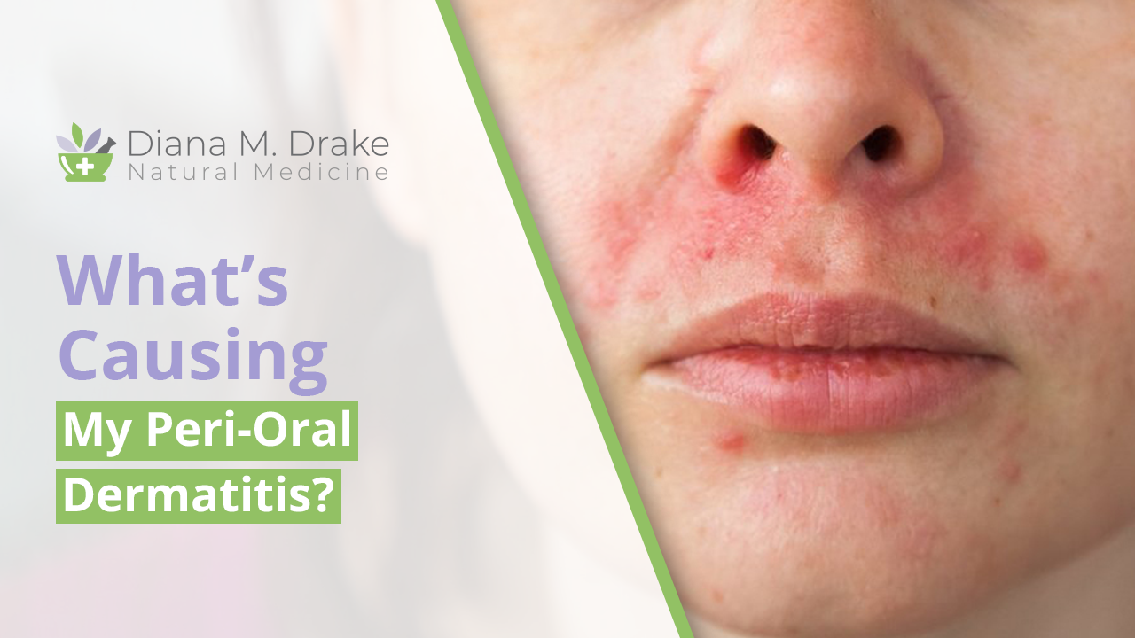 
What's Causing My Peri-Oral Dermatitis?